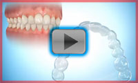 How invisalign works