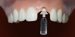 Implant process 2
