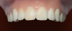 Veneers process 3
