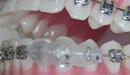 Fixed braces some FAQs - Irritation of Lips or Cheeks