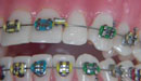 Fixed braces some FAQs - Loose Brackets, Wires or Bands
